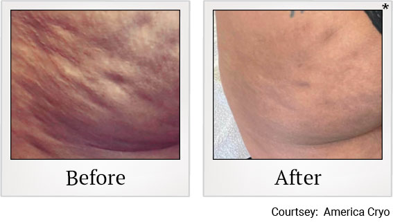 Results 5 of cryotherapy treatment at Granite Bay Medical Center in Roseville