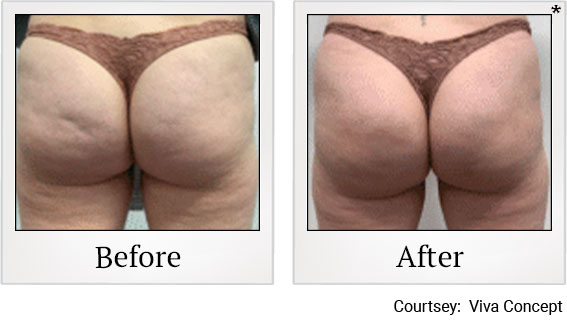 Fat reduction results 1 at Granite Bay Medical Center in Roseville