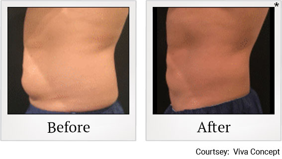 Results 4 of liposonix treatment at Granite Bay Medical Center in Roseville