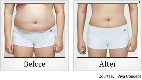 Fat reduction results 3 at Granite Bay Medical Center in Roseville