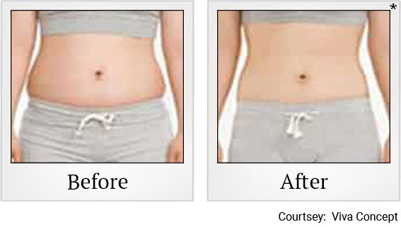 Results 7 of liposonix treatment at Granite Bay Medical Center in Roseville