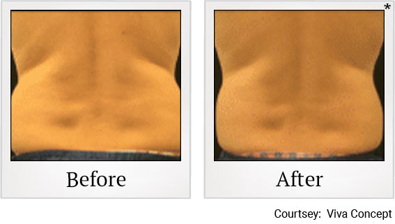 Results 8 of liposonix treatment at Granite Bay Medical Center in Roseville