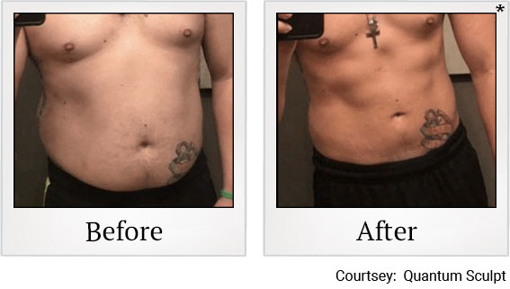 QSculpt results 2 at Granite Bay Medical Center in Roseville