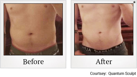 Results 10 of qsculpt treatment at Granite Bay Medical Center in Roseville