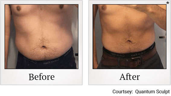 Results 11 of qsculpt treatment at Granite Bay Medical Center in Roseville