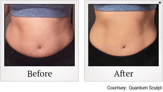 Results 12 of qsculpt treatment at Granite Bay Medical Center in Roseville