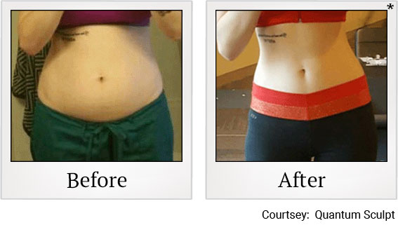 QSculpt results 1 at Granite Bay Medical Center in Roseville