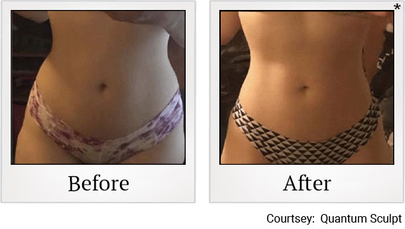 Results 3 of qsculpt treatment at Granite Bay Medical Center in Roseville