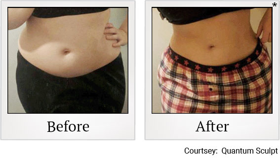 Results 4 of qsculpt treatment at Granite Bay Medical Center in Roseville