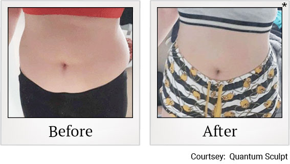 Results 5 of qsculpt treatment at Granite Bay Medical Center in Roseville