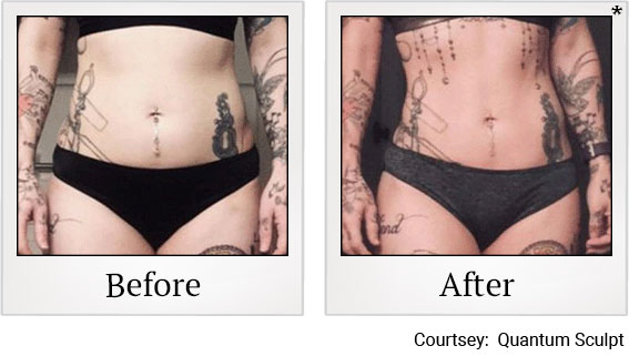 QSculpt results 3 at Granite Bay Medical Center in Roseville