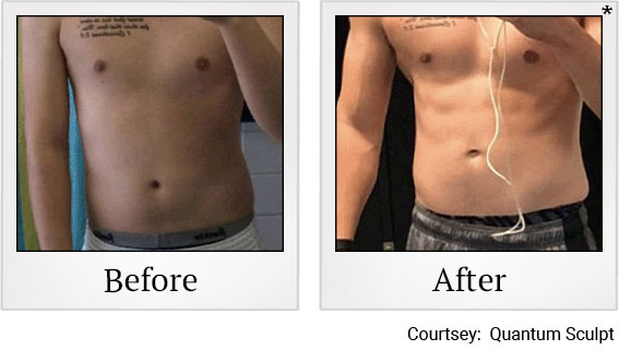 Results 7 of qsculpt treatment at Granite Bay Medical Center in Roseville