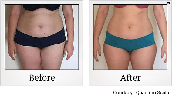 Results 8 of qsculpt treatment at Granite Bay Medical Center in Roseville