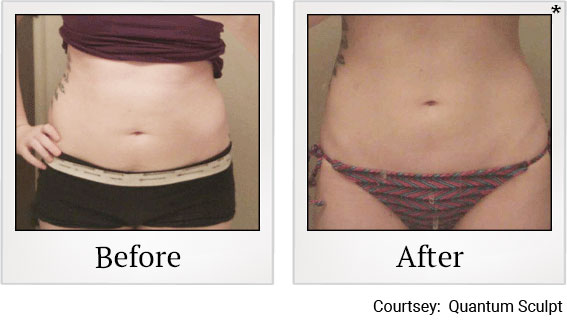 Results 9 of qsculpt treatment at Granite Bay Medical Center in Roseville