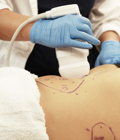 LipoSonix on abdominal at Granite Bay Medical Center in Roseville